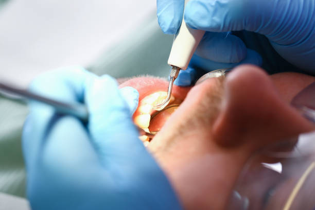 Best Emergency Root Canal Treatment in Woodbury, MN